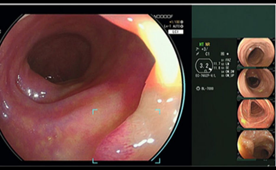 Fujifilm Receives FDA Clearance for AI Detection System CAD EYE in Endoscopic Imaging